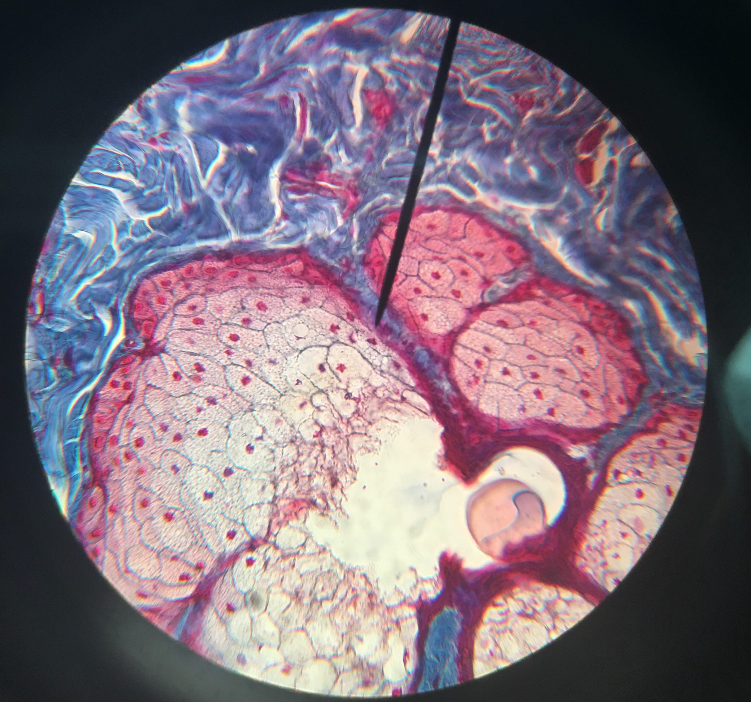 CIN 1, CIN 2 ve CIN 3